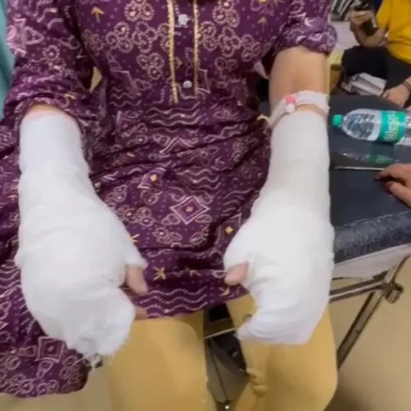 Delhi University acid attack