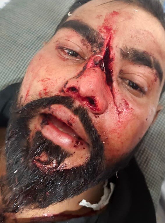 Two Muslim Transport Workers Attacked by Armed Gang Near Umarkhed, Left Critically Injured