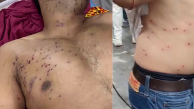 Delhi Protest Crackdown: Teen May Lose Vision as Pellet Injury Allegations Mount; Police Deny Use