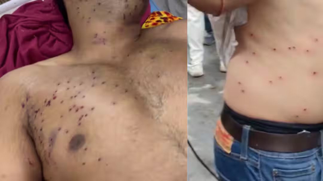 Fresh Pellet Gun Allegations Emerge After Delhi Protest; Two Undergo Surgery, Teen Risks Losing Vision